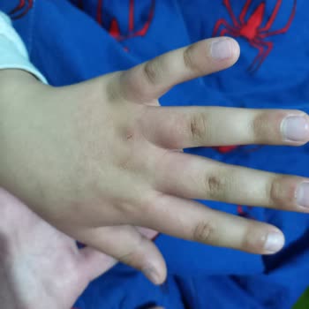 Tereson Alerjisi Uyku Uyutmuyor