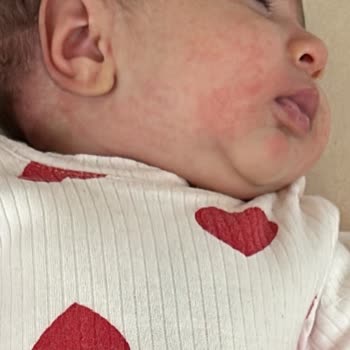 Mustela Şampuan Bebeğimin Yüzünü Alerji Yaptı.