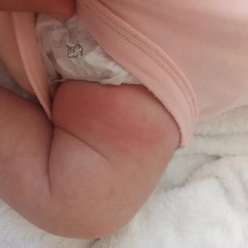 Mustela Krem Alerji Yaptı Bebeğime