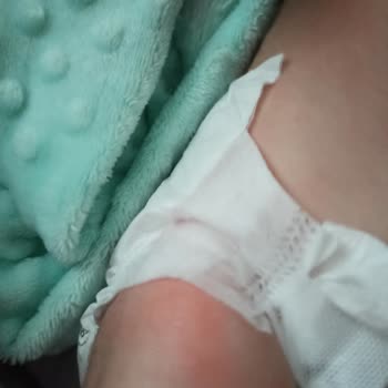 Mustela Krem Alerji Yaptı Bebeğime