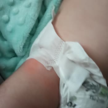 Mustela Krem Alerji Yaptı Bebeğime