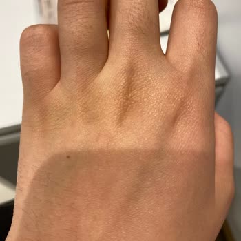 Dilan Polat Estetik Arnavutköy Lazer Seansı Hayal Kırıklığı Ve İlgisizlik