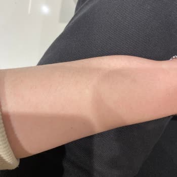 Dilan Polat Estetik Arnavutköy Lazer Seansı Hayal Kırıklığı Ve İlgisizlik