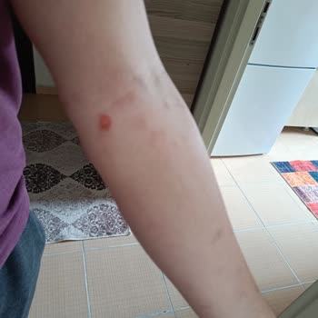 Esse Life Başakşehir Lazerde Yaktılar!