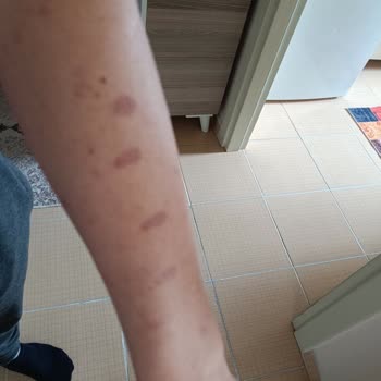 Esse Life Başakşehir Lazerde Yaktılar!