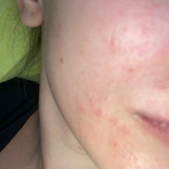 Procsin Ürünleri Yüzümün Her Yerini Mahvetti