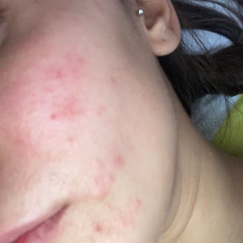 Procsin Ürünleri Yüzümün Her Yerini Mahvetti