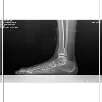 İstanbul Haseki Eğitim Ve Araştırma Hastanesi Sol Ayak Şikayeti Yanlış Anlaşıldı