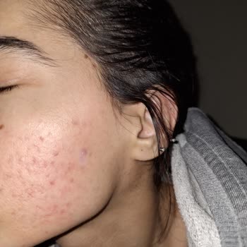 Recete.com Bioderma Photoderm Aquafluid Akne Ve Komedon Yapıyor