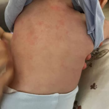 Mustela Göğüs Balsamı Kırmızı Lekeler Yaptı