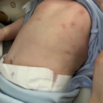 Mustela Göğüs Balsamı Kırmızı Lekeler Yaptı