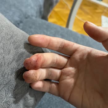 Dexcom Kan Şekeri Hatası