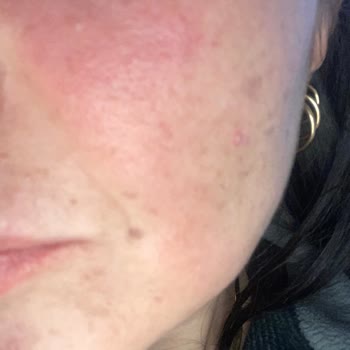 Procsin Yüz Serumları Şikayet