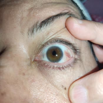 Acıbadem Hastanesi Kayseri'de Göz Hastalıkları Doktoruyla İlgili Yaşanan Mağduriyet