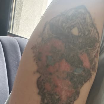 Eforya Clinic Dövme Silme Yanık