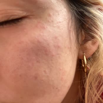 Need Cosmetics Sabun Yüzümü Mahvetti