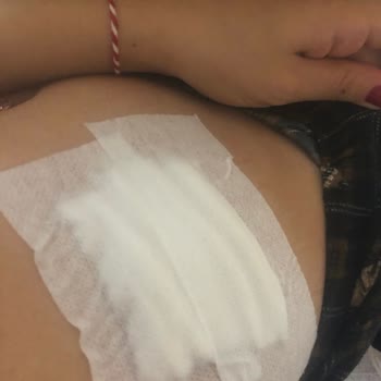 Opia Beauty Lounge Lazer Camı Üzerimde Patladı Ve Yaktı