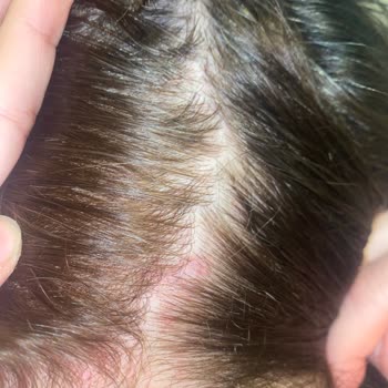 Garnier Haarfarbe beschwerde wegen allergische Reaktion und Farbverlust