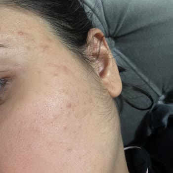 PelCare Yüzüm Alerji Yaptı