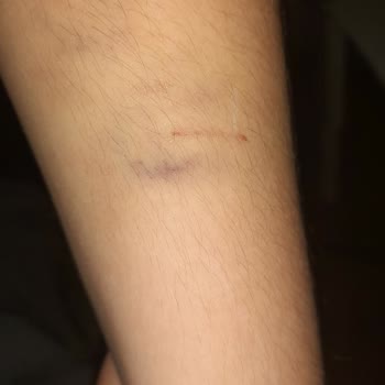 İzmir Konak Belediyesi Kopek Isırması Ve Belediyenin Çözümsüzlüğü