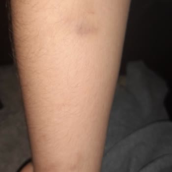 İzmir Konak Belediyesi Kopek Isırması Ve Belediyenin Çözümsüzlüğü