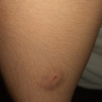 İzmir Konak Belediyesi Kopek Isırması Ve Belediyenin Çözümsüzlüğü