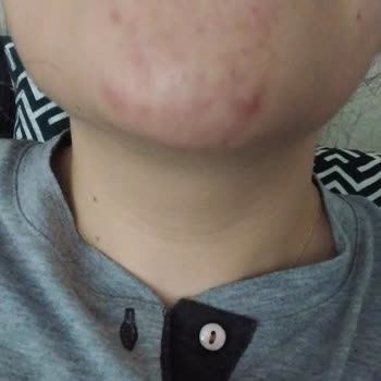 Vione Akne Gibi Değildi.