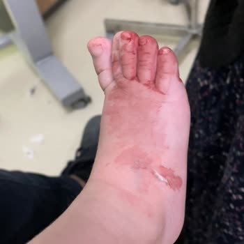 Özel Nev Hospital (Şanlıurfa) Bir Damaryolu Nasıl Açılmaz