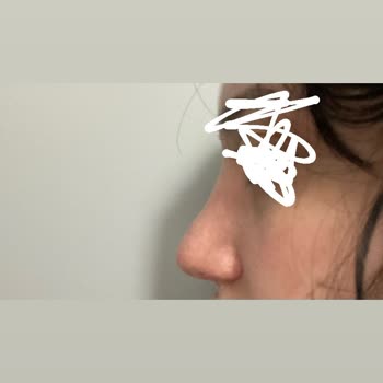 British Esthetic Estetik Sonrası Yaşanan Memnuniyetsizlik Durumu