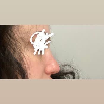 British Esthetic Estetik Sonrası Yaşanan Memnuniyetsizlik Durumu