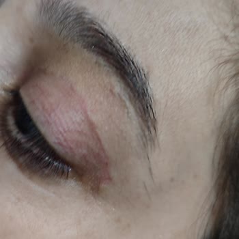 Estethica Zorunlu Göz Kapağı Ameliyatı