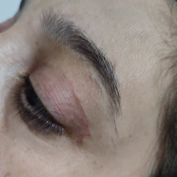 Estethica Zorunlu Göz Kapağı Ameliyatı