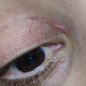 Estethica Zorunlu Göz Kapağı Ameliyatı