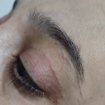 Estethica Zorunlu Göz Kapağı Ameliyatı