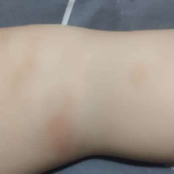 Mustela Ürünleri Çocuğumun Vücudunda Sorun Yarattı