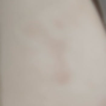 Mustela Ürünleri Çocuğumun Vücudunda Sorun Yarattı