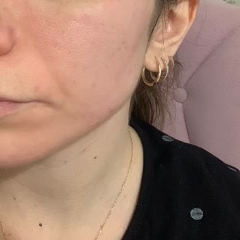 Yves Rocher Kil Maskesi Alerji Yaptı