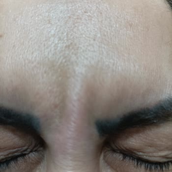 Yeni Yüzyıl Üniversitesi Gaziosmanpaşa Hastanesi Botoks Uygulamasından Memnun Değilim