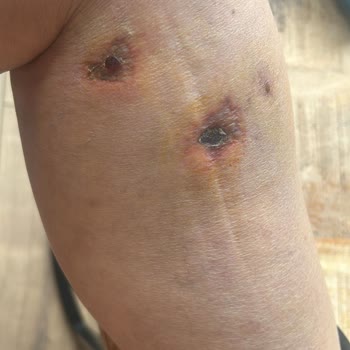 Prof. Dr. Kürşat Bozkurt Yüzünden Bacağımı Kaybediyordum!