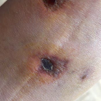 Prof. Dr. Kürşat Bozkurt Yüzünden Bacağımı Kaybediyordum!