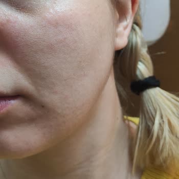 Maruderm Kozmetik Ürünlerini Yüzümde Yanma Kabartma Kaşıntı