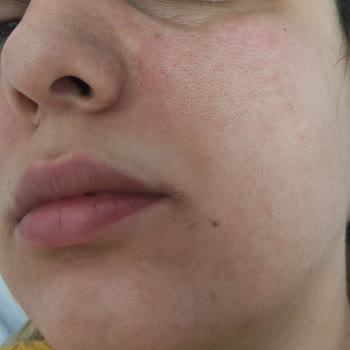 Maruderm Kozmetik Ürünlerini Yüzümde Yanma Kabartma Kaşıntı