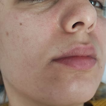 Maruderm Kozmetik Ürünlerini Yüzümde Yanma Kabartma Kaşıntı