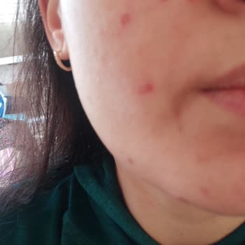 Dilan Polat Estetik Cilt Bakımı Sonrası Beklenmedik Tepki Ve Şube İlgisizliği