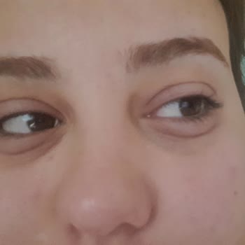 Maruderm Gözaltı Serumu Gözlerimi Şişirdi