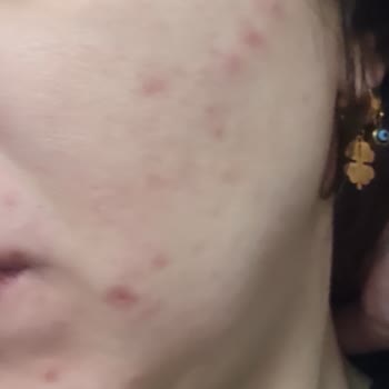 Loreal Salisilik Asit Yikama Jeli Kullanmamalı