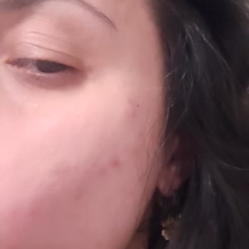 Loreal Salisilik Asit Yikama Jeli Kullanmamalı