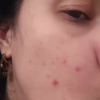 Loreal Salisilik Asit Yikama Jeli Kullanmamalı