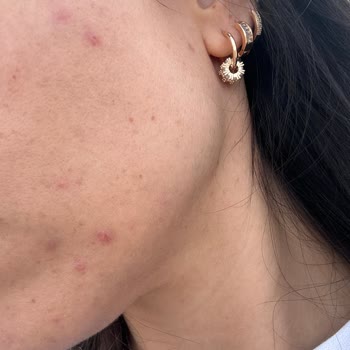 La Roche Posay Leke Serumu Cildimi Mahvetti