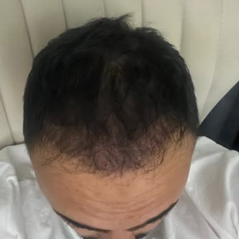 Antalya Medical Park Saç Ekimi